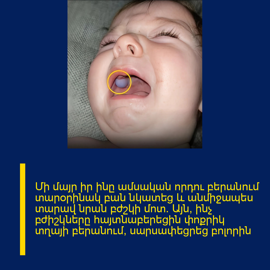 Մի մայր իր ինը ամսական որդու բերանում տարօրինակ բան նկատեց և անմիջապես տարավ նրան բժշկի մոտ։ Այն, ինչ բժիշկները հայտնաբերեցին փոքրիկ տղայի բերանում, սարսափեցրեց բոլորին