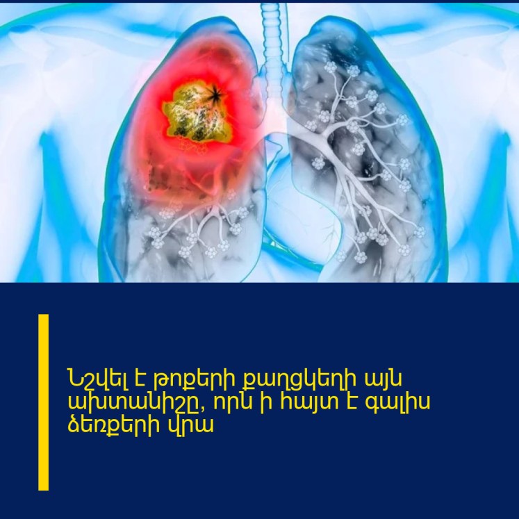 Նշվել է թոքերի քաղցկեղի այն ախտանիշը, որն ի հայտ է գալիս ձեռքերի վրա