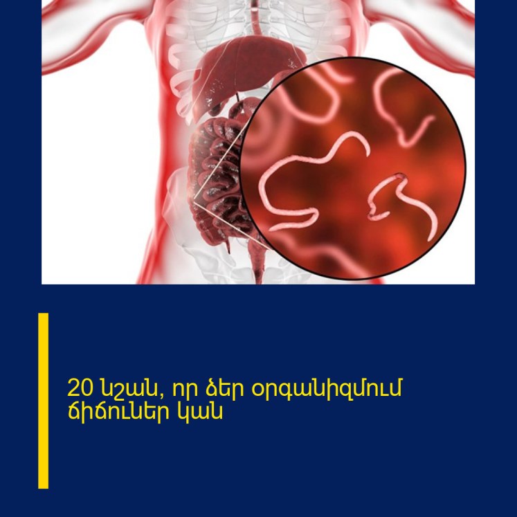20 նշան, որ ձեր օրգանիզմում ճիճուներ կան 20 նշան, որ ձեր օրգանիզմում ճիճուներ կան