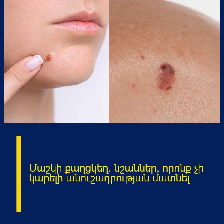 Մաշկի քաղցկեղ. նշաններ, որոնք չի կարելի անուշադրության մատնել Մաշկի քաղցկեղ. նշաններ, որոնք չի կարելի անուշադրության մատնել