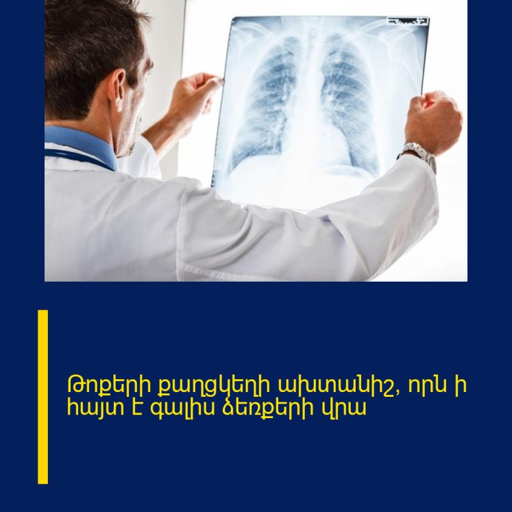 Թոքերի քաղցկեղի ախտանիշ, որն ի հայտ է գալիս ձեռքերի վրա Թոքերի քաղցկեղի ախտանիշ, որն ի հայտ է գալիս ձեռքերի վրա